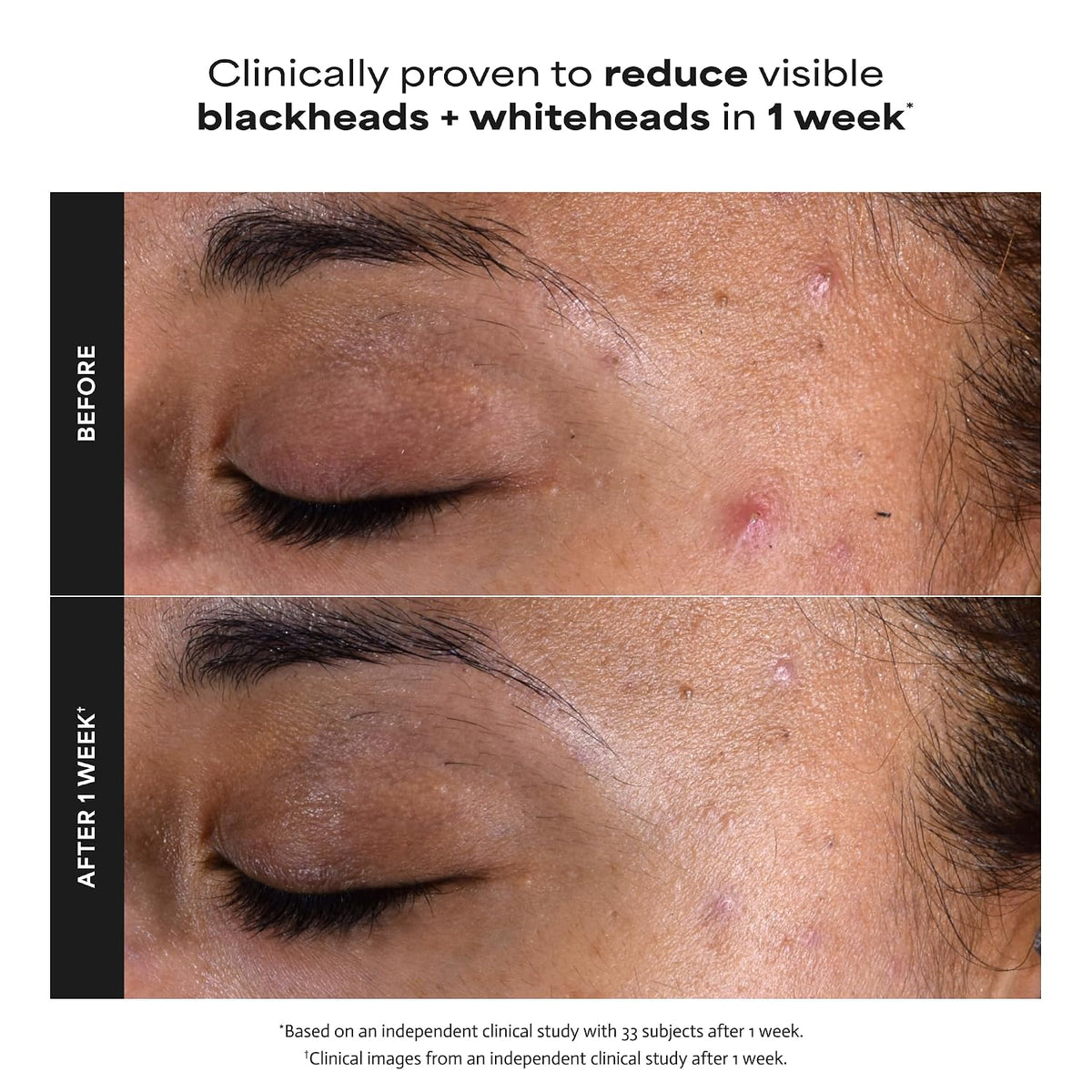 Paula's Choice SKIN PERFECTING 2% BHA Liquid Leave-On Exfoliant